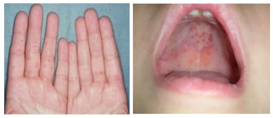 petua cepat hilangkan HFMD anak