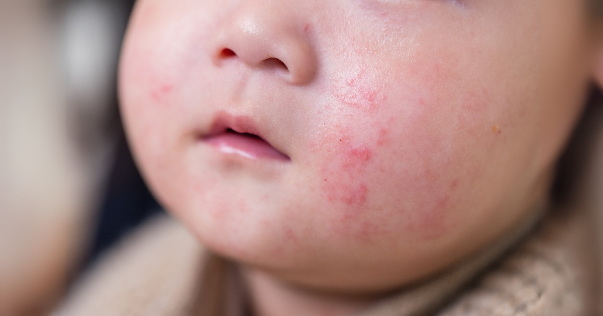 Kenapa Anak Kena Eczema