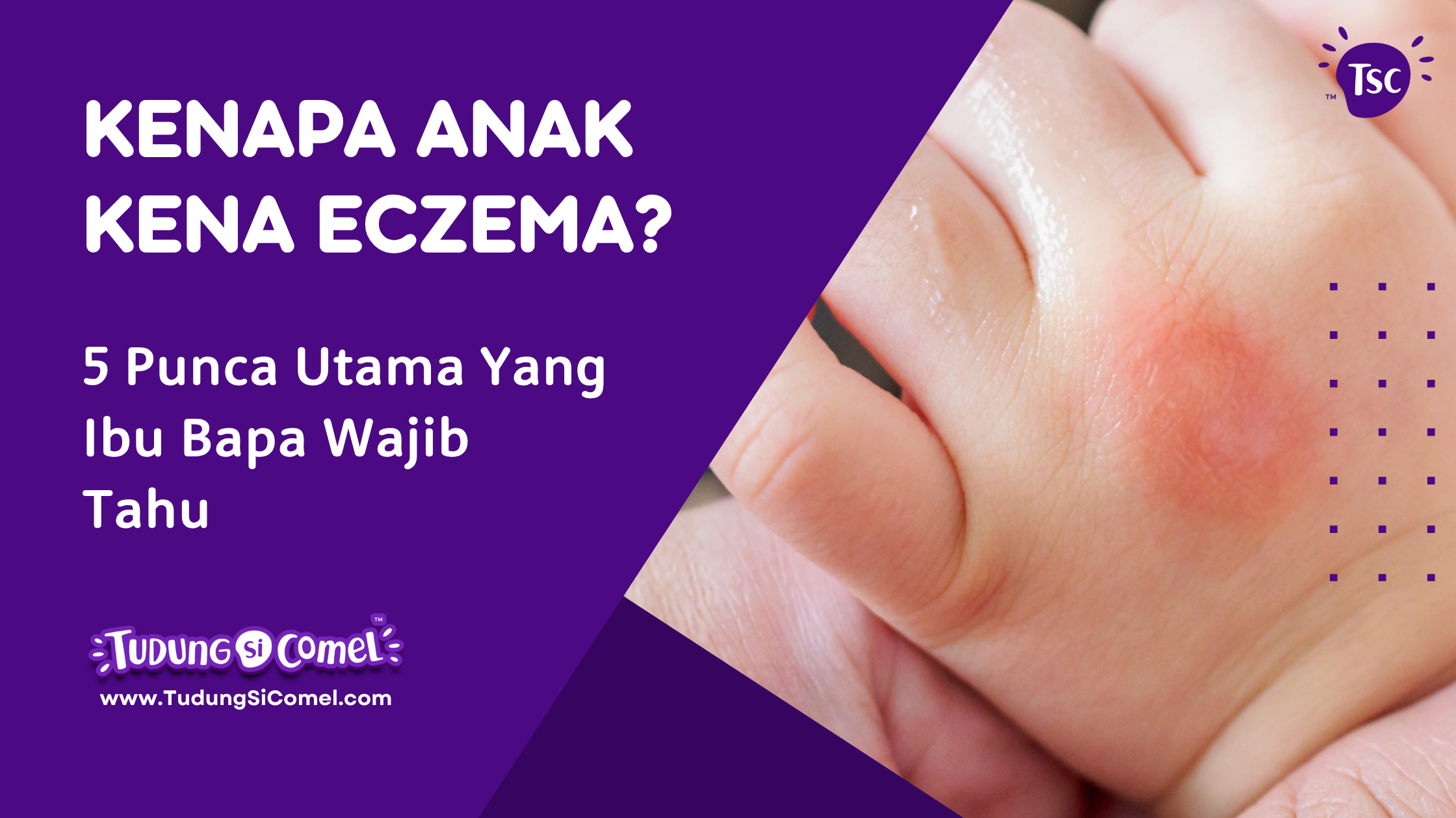 punca anak kena eczema